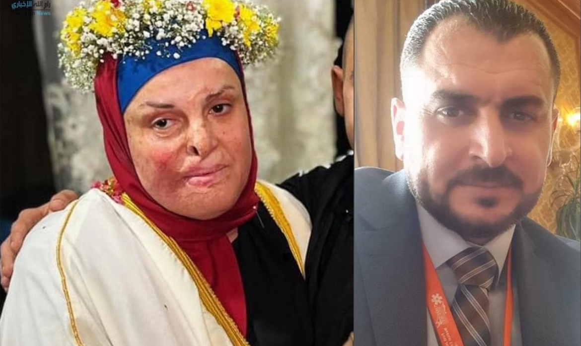 دكتور اردني يتكفّل بعداج الأسيرة المحررة إسراء الجعافيص