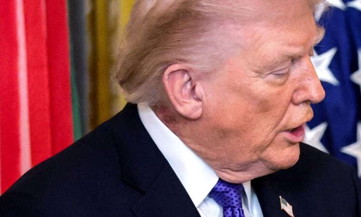 طبيب: ترامب يستخدم علاجا وقائيا لطفح جلدي ظهر على رقبته