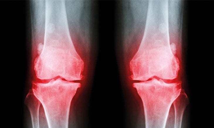 اختراق علمي لتجديد المفاصل المتقدمة في العمر قد يساعد في علاج العظام